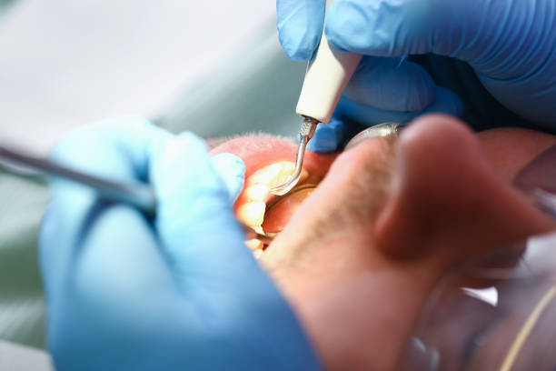 Best Emergency Treatment for Toothache in San Luis Obispo, CA